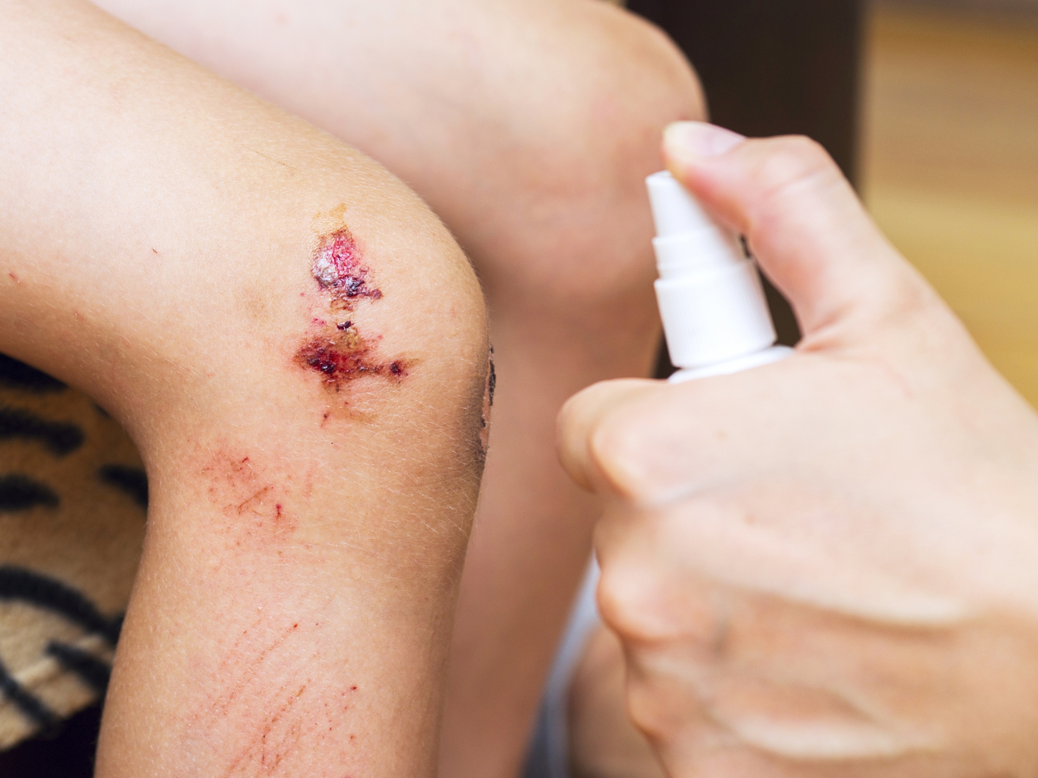 Womans hand sprays an antiseptic agent on the wound on the child?s knee. Treatment the wound. First Aid.